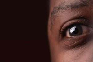 Cataract Surgery Following LASIK in Nigeria